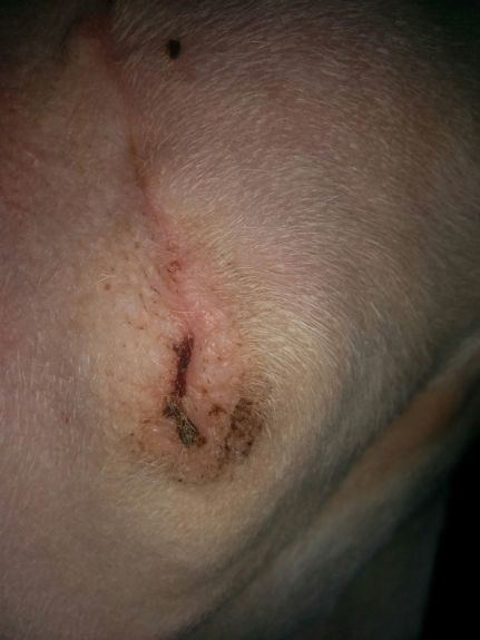 Amputation Scar